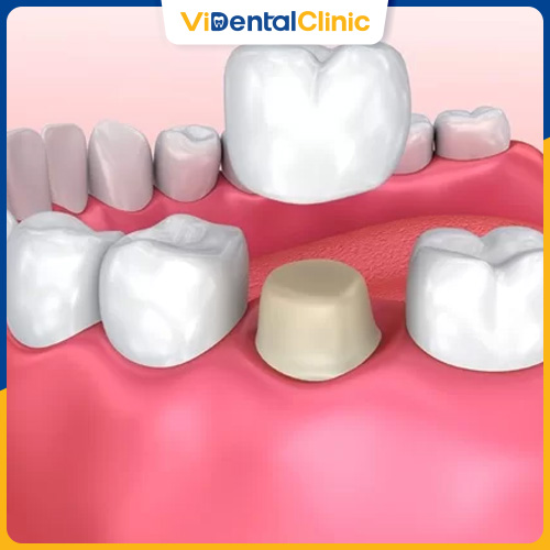 Bọc răng sứ là giải pháp hoàn hảo khi răng số 6 bị sâu nặng