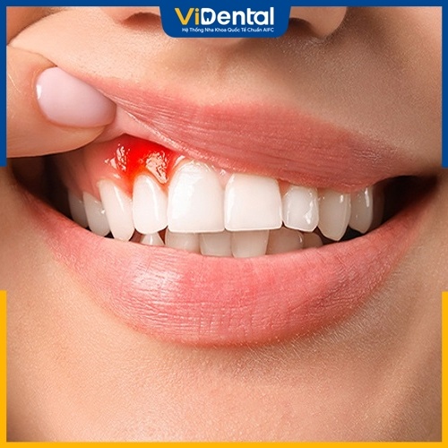 Hỏng răng sứ gây nhiều hệ lụy đến sức khỏe răng miệng