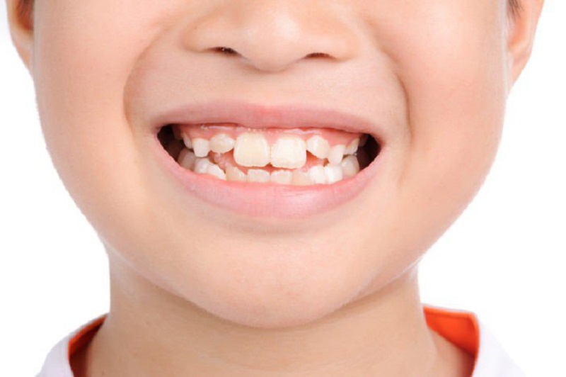 Răng mọc lẫy ảnh hưởng đến thẩm mỹ của trẻ rất nhiều