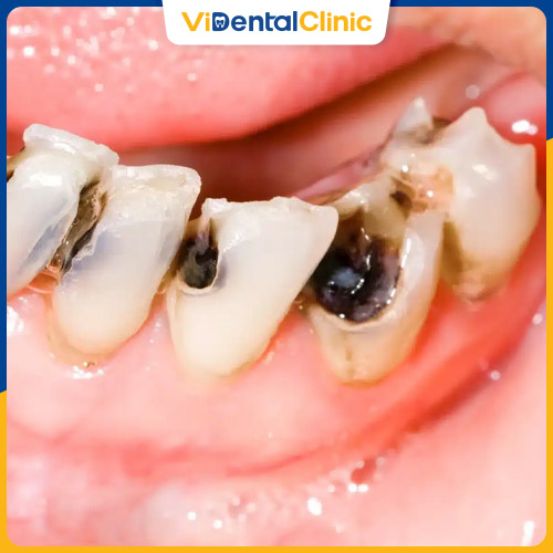 Sâu răng nặng là tình trạng lớp men răng, ngà răng bị phá hủy