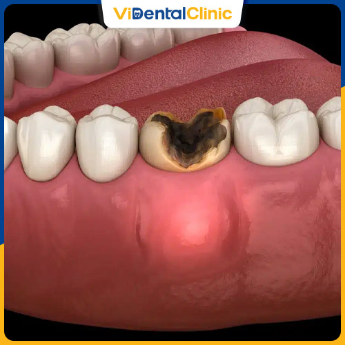 Có nhiều nguyên nhân dẫn đến tình trạng sâu răng nặng