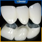 Nhiều người quan tâm việc so sánh răng sứ Zirconia và Cercon