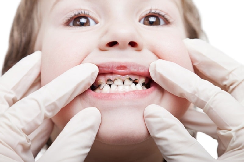 Cha mẹ cần tìm hiểu nguyên nhân gây sún răng của bé để có phương pháp điều trị