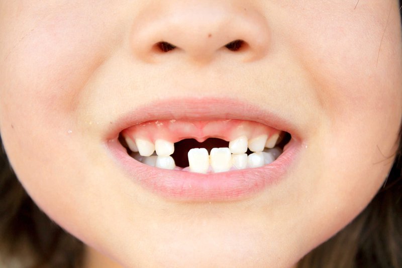 Mất răng sớm có thể khiến xương hàm của bé phát triển không cân đối
