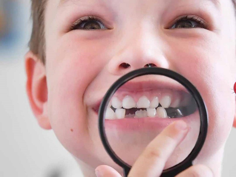 Sún răng là bệnh răng miệng phổ biến ở trẻ em