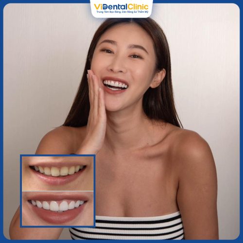 Hình ảnh khách hàng sau khi tẩy trắng răng tại Trung Tâm ViDental Clinic