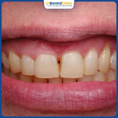 Trám răng cửa bị sâu là phương pháp khắc phục răng sâu hiệu quả