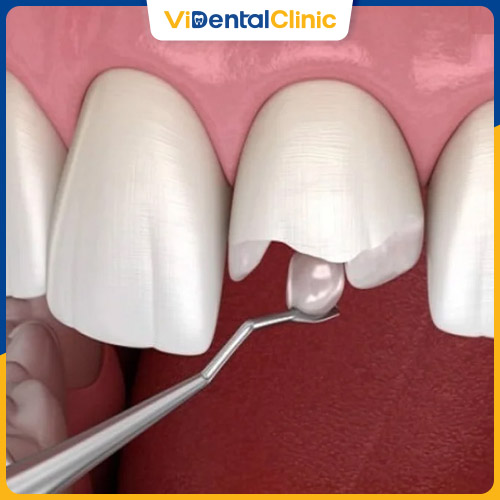Trám răng cửa bị sâu nặng thường ít đau nhức