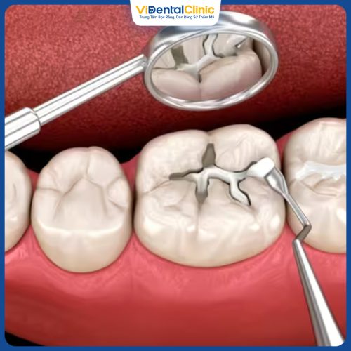 Quy trình trám răng cần được thực hiện đúng chuẩn, đảm bảo an toàn