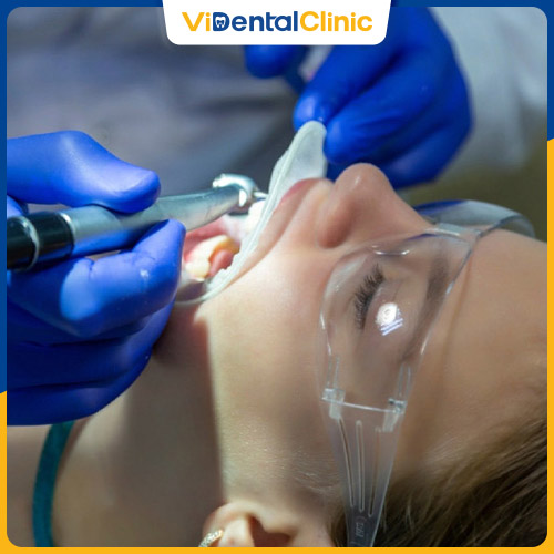 Quy trình trám răng sâu chuẩn Y khoa gồm 4 bước