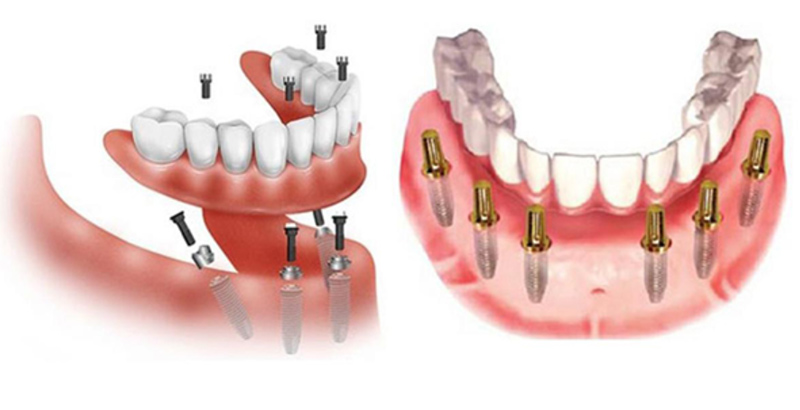 Cấy ghép Implant là phương pháp trồng răng nguyên hàm tối ưu nhất