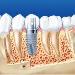 Cấy ghép implant có thời gian thực hiện lâu hơn cầu răng sứ