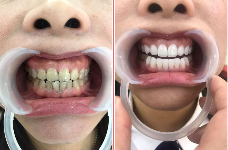 hình ảnh trước và sau khi bọc răng sứ