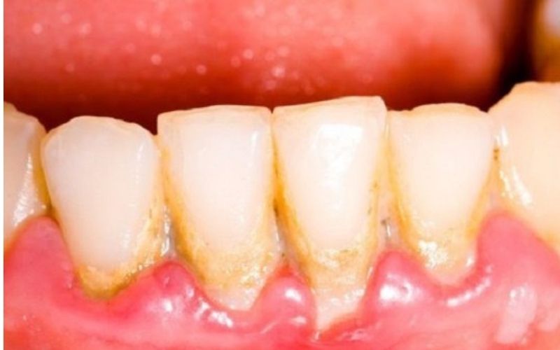 Cao răng là mối nguy hại đến sức khỏe răng miệng