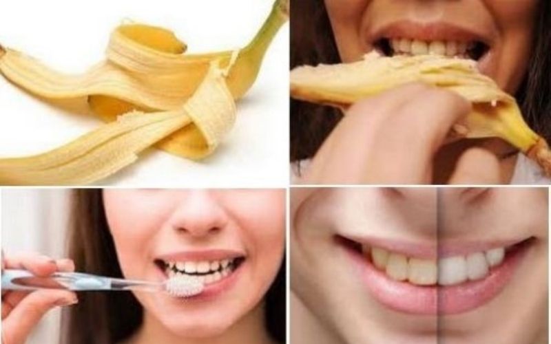 Tự lấy cao răng bằng vỏ chuối đơn giản và hiệu quả