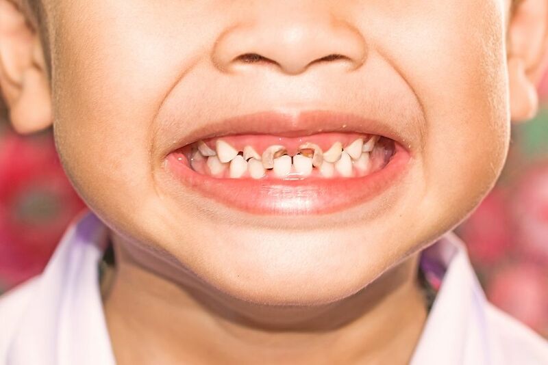 Sâu răng là một trong số những hệ lụy nghiêm trọng khi trẻ chậm mọc răng