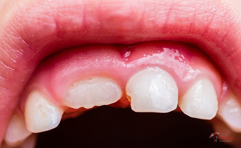 Viêm nướu răng ở trẻ em là biểu hiện nhẹ của bệnh viêm nha chu gây đau nhức