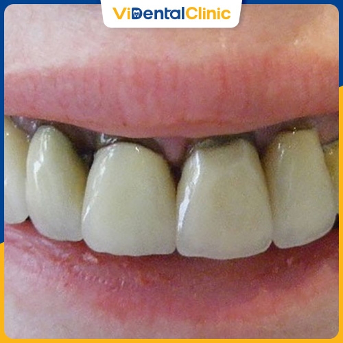 Chân răng bị đen xảy ra do mảng bám tích tụ