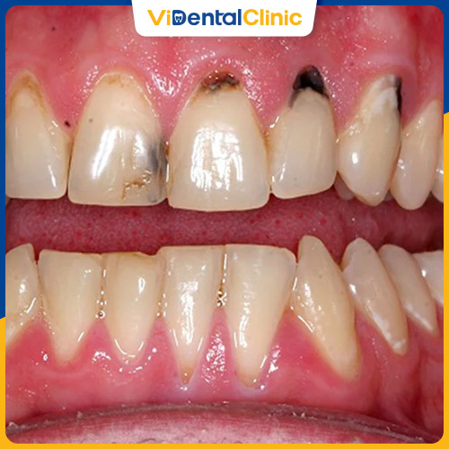 Đen chân răng ảnh hưởng đến thẩm mỹ của hàm răng
