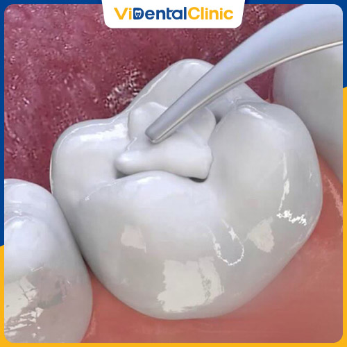 Trám răng khắc phục tình trạng chân răng đen do sâu răng