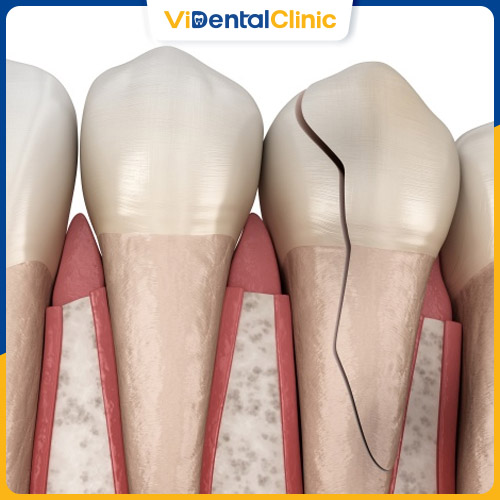 Răng cửa bị nứt nghiêm trọng có khả năng mất răng vĩnh viễn