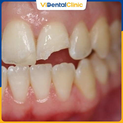 Có nhiều phương pháp xử lý khi răng bị gãy còn chân răng