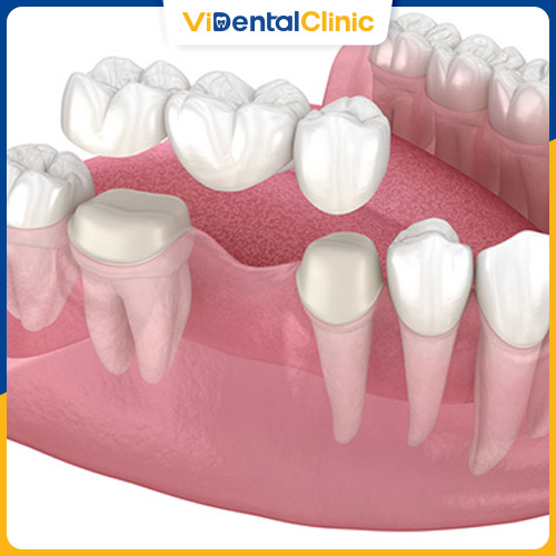 Bắc cầu răng sứ phù hợp khi răng bị gãy nhiều