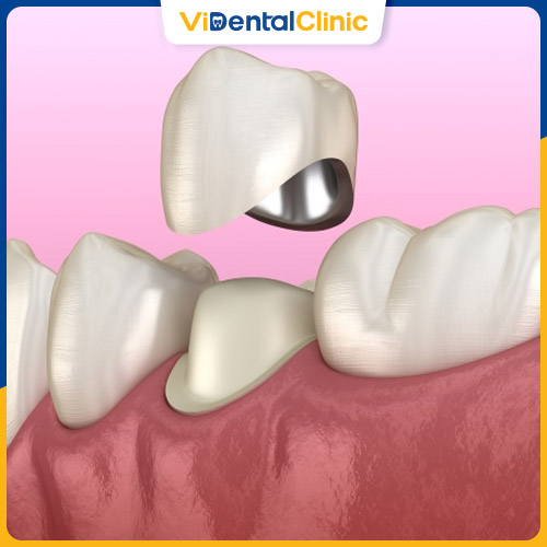 Bọc răng sứ khắc phục hiệu quả tình trạng nứt răng