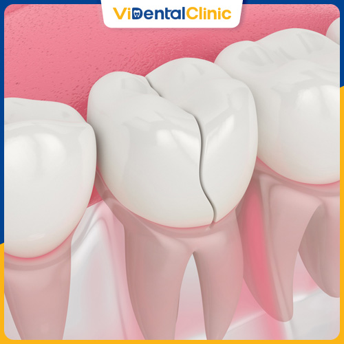 Răng nứt dọc là tình trạng thường gặp
