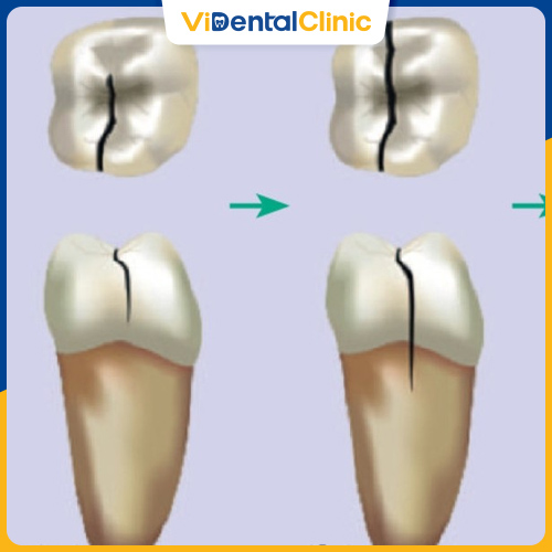 Răng bị nứt dọc có nhiều mức độ từ nhẹ đến nặng