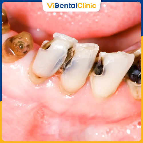 Sâu răng xảy ra do vệ sinh răng miệng kém