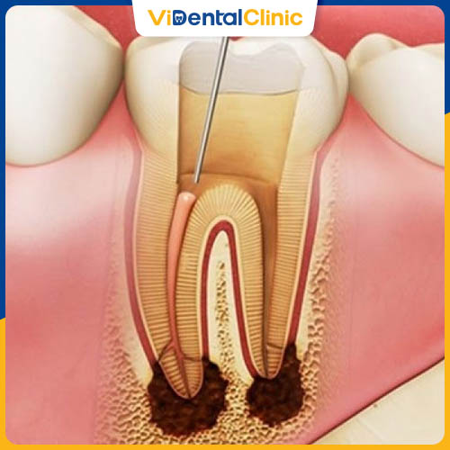 Lấy tủy răng được áp dụng khi răng bị sâu nặng