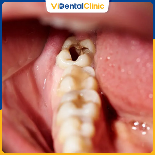 Răng khôn bị sâu nặng khiến cấu trúc răng bị phá hủy