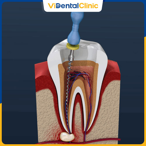 Bác sĩ có thể chỉ định điều trị tủy và trám răng