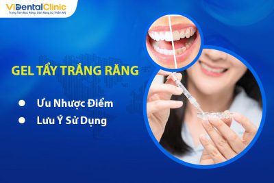 Gel Tẩy Trắng Răng Là Gì? Ưu Nhược Điểm, Lưu Ý Sử Dụng