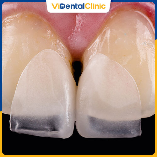 Răng sứ Vita có giá từ 3.000.000 - 12.000.000 VNĐ/răng
