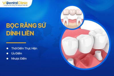 Bọc Răng Sứ Dính Liền Là Gì? Thời Điểm Thực Hiện Và Ưu, Nhược Điểm