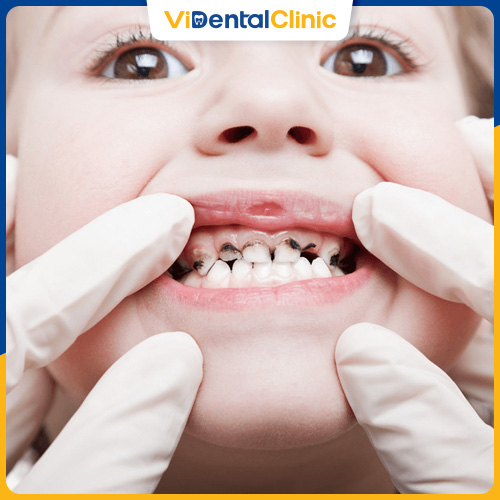 Độ tuổi phù hợp nhất để bọc răng sứ là từ 18 tuổi trở lên