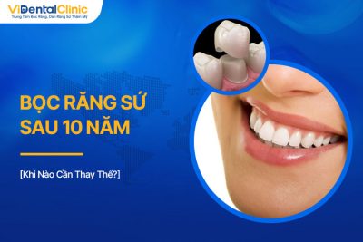 Bọc Răng Sứ Sau 10 Năm: Khi Nào Cần Thay Thế?