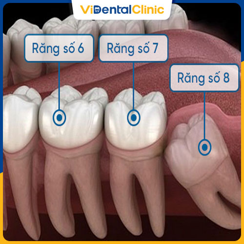 Bọc sứ cho răng số 7 giúp bảo vệ răng thật