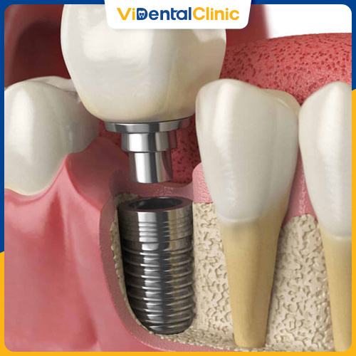 Khi răng số 7 bị mất, cấy ghép Implant là lựa chọn tối ưu