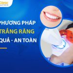 Các Phương Pháp Tẩy Trắng Răng Hiệu Quả, An Toàn Hiện Nay