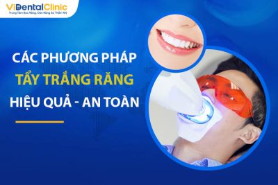 Các Phương Pháp Tẩy Trắng Răng Hiệu Quả, An Toàn Hiện Nay