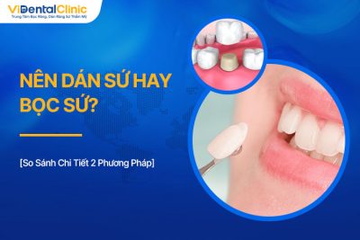 Nên Dán Sứ Hay Bọc Sứ? So Sánh Chi Tiết 2 Phương Pháp