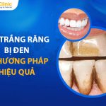 Tẩy Trắng Răng Bị Đen Được Không? 8 Phương Pháp Hiệu Quả 