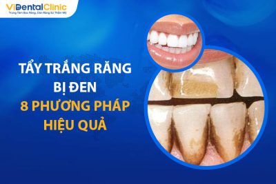 Tẩy Trắng Răng Bị Đen Được Không? 8 Phương Pháp Hiệu Quả 