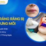 Tẩy Trắng Răng Bị Sưng Môi: Nguyên Nhân Và Cách Xử Lý