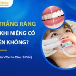 Có Nên Tẩy Trắng Răng Sau Khi Niềng? Cần Lưu Ý Gì?