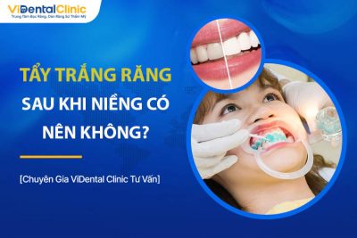 Có Nên Tẩy Trắng Răng Sau Khi Niềng? Cần Lưu Ý Gì?