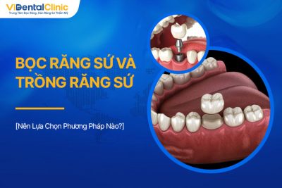 Bọc Răng Sứ Và Trồng Răng Sứ: Nên Chọn Phương Pháp Nào?